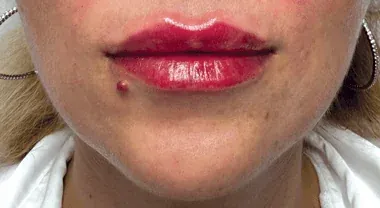 Usta – po zabiegu